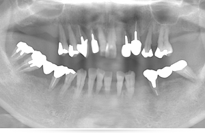 名古屋のインプラント治療を専門とする歯医者、クリスタル歯科のインプラント治療例
