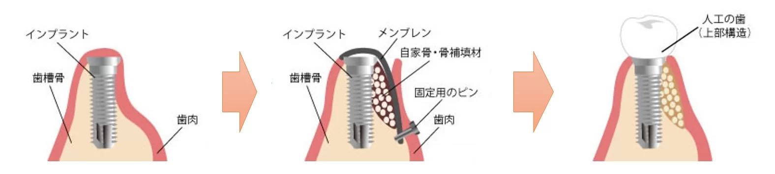 名古屋のインプラント治療の専門歯科医院クリスタル歯科のインプラント付加的治療