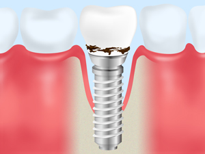 名古屋のインプラント治療の専門歯科医院クリスタル歯科のメンテナンス