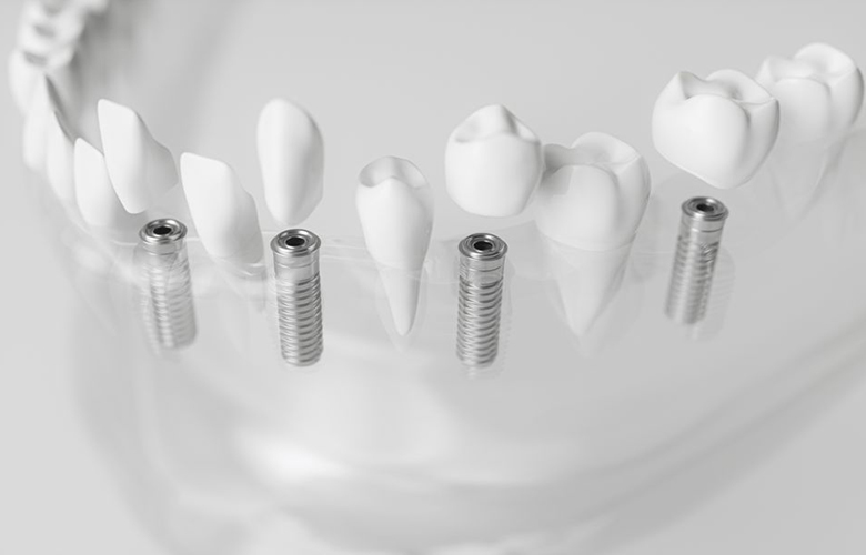 名古屋のインプラント治療を専門とする歯医者、クリスタル歯科は1回の手術で何本でも治療可能